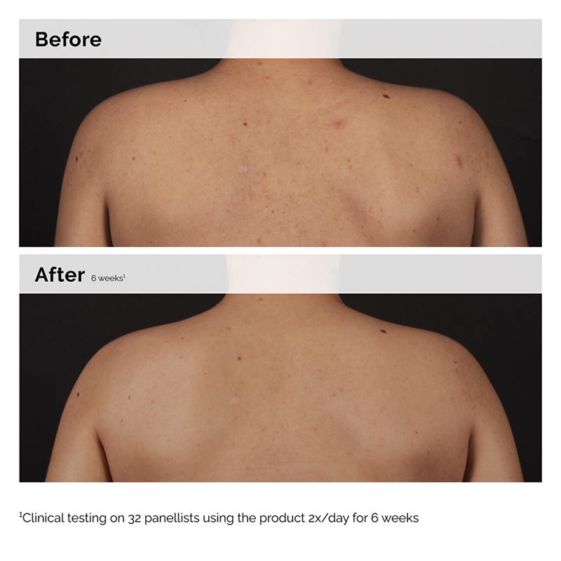 Salicylic Acid 0.5% Body Serum